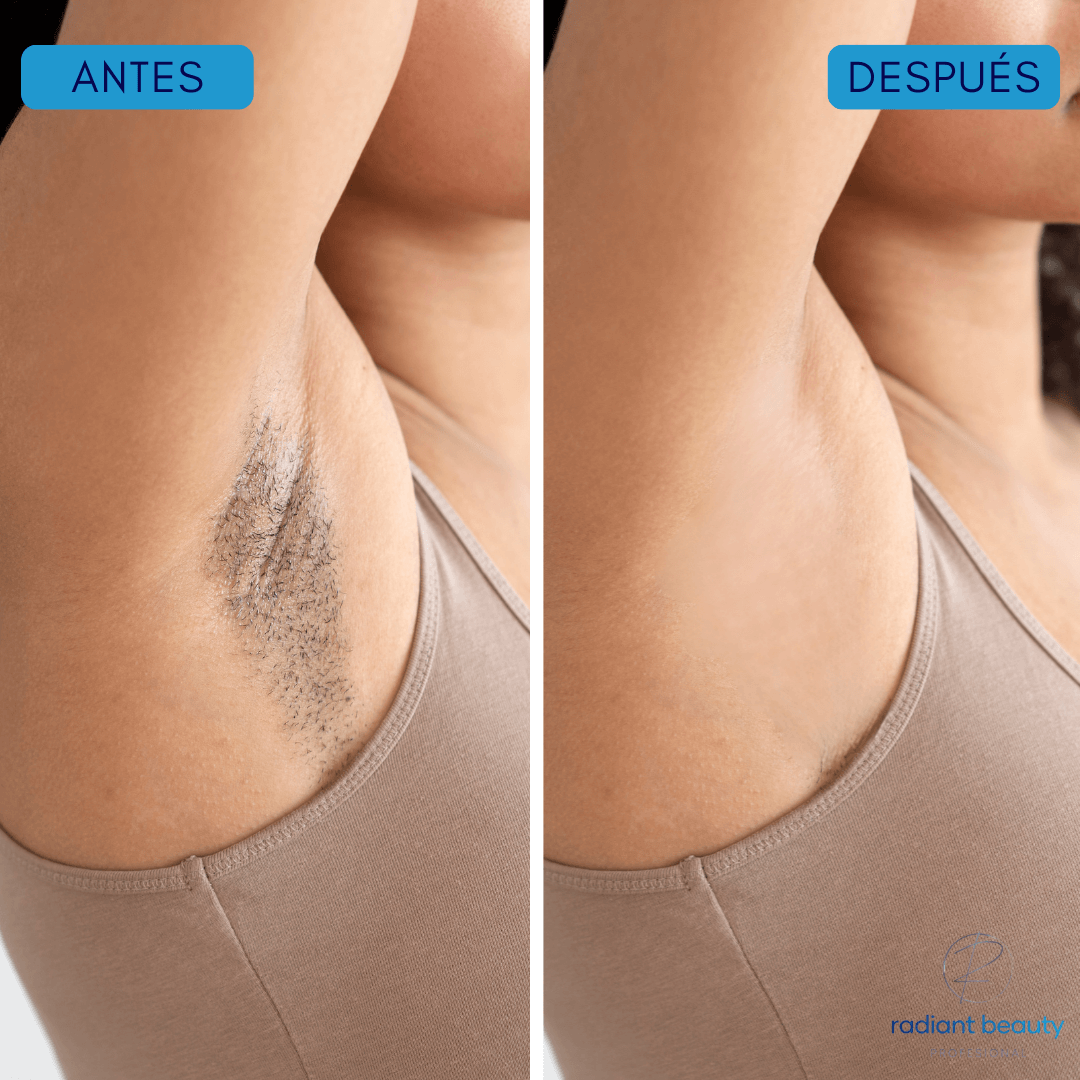 Radiantwave™ - Depiladora laser profesional